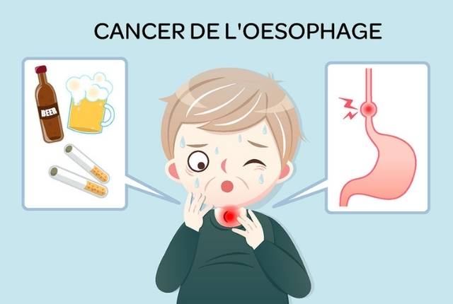 Se Bruler L Oesophage En Mangeant Trop Chaud Cancer de l'œsophage : définition, causes, traitement | Elsan